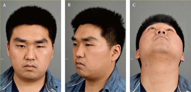 Reconstruction of Critical Sized Maxillofacial Defects Using Composite Allogeneic Tissue Engineering