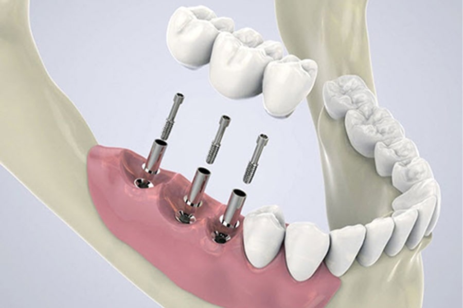 Advantages of digital dentistry