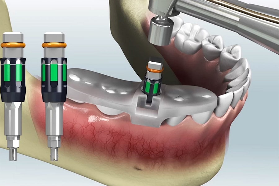 What are the different methods of digital dentistry?