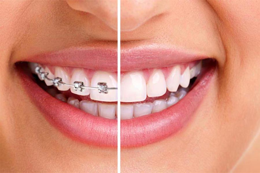 Orthodontic treatment process