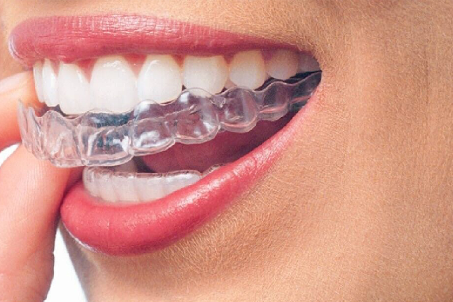 Treatment process with clear aligner