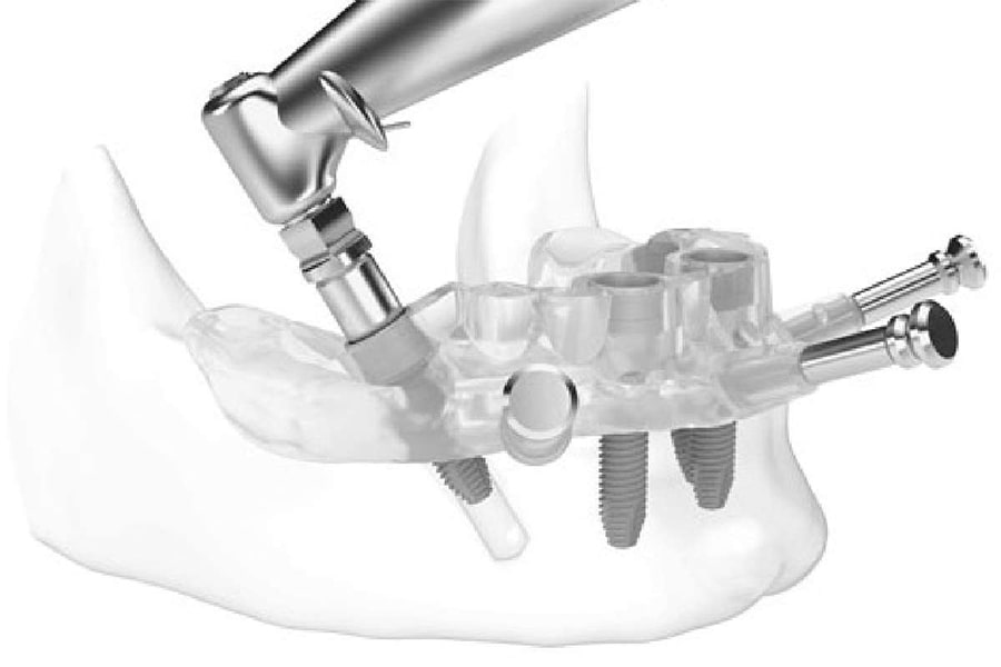 Digital Implant An Innovative Method for Replacing Lost Teeth