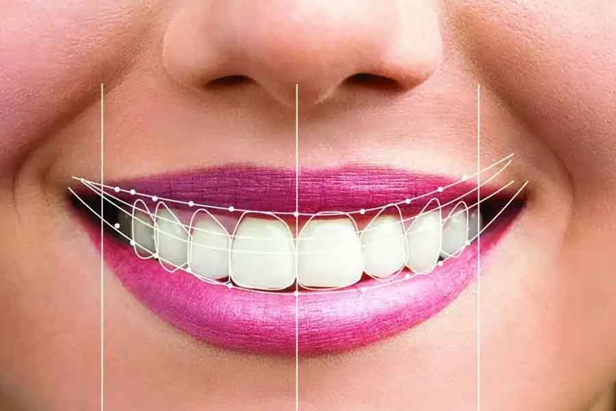طراحی لبخند دیجیتال (DSD): دقیق‌ترین روش برای رسیدن به لبخند ایده‌آل